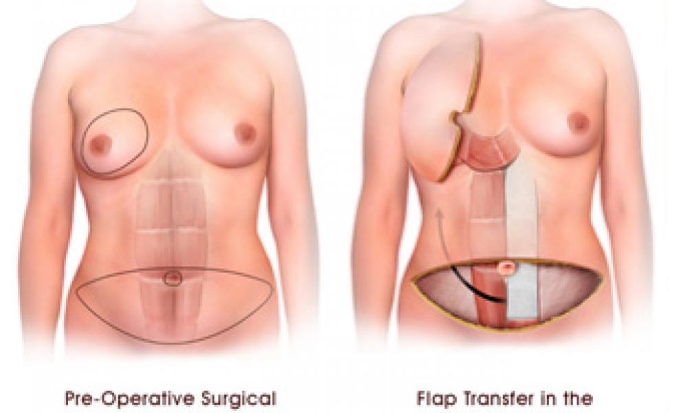 Medical drawing of Pedicled TRAM flap showing a before and after image of a flap from the bottom abdomen being moved to the breast muscle